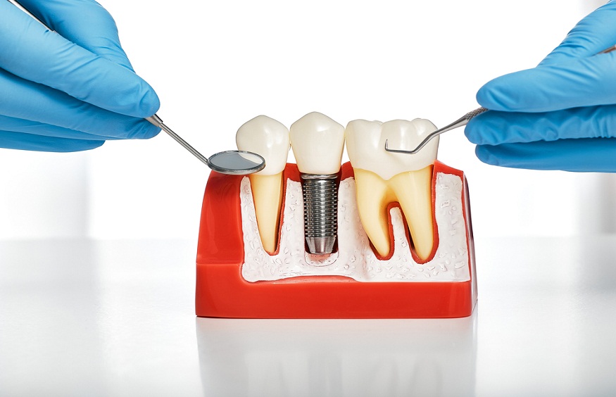 3D Printing In Cosmetic Dentistry