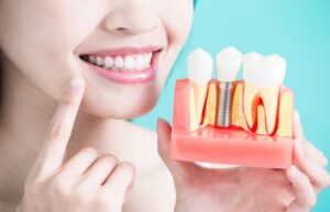 Care for Your Dental Implants