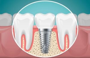 Replacement Roots for Lost Teeth