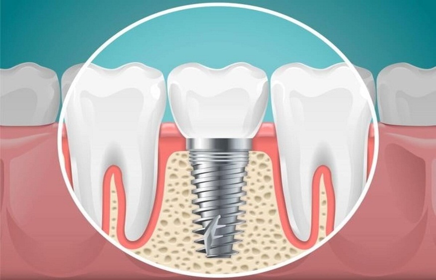 Replacement Roots for Lost Teeth