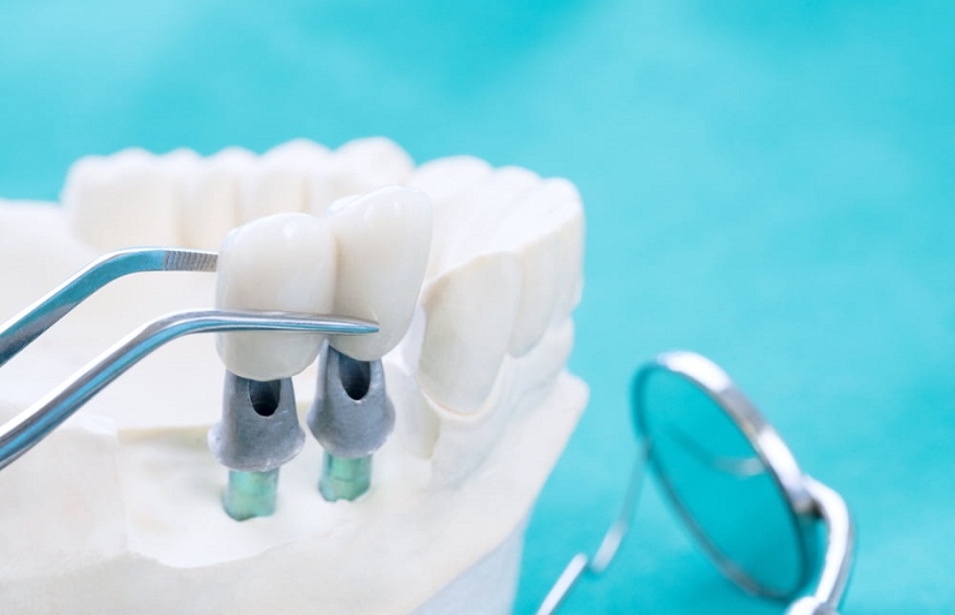 Dental Bridge Patients