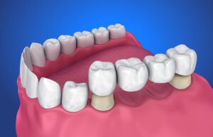 Dentures or Dental Bridge