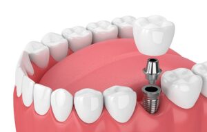 Implant Dentist